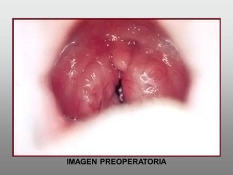 Hipertrofia image001
